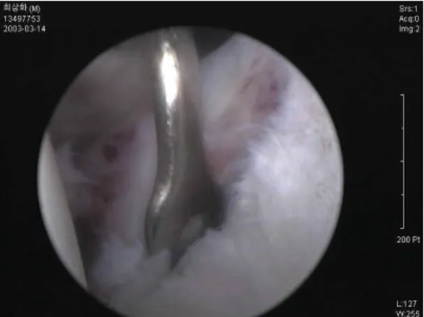 Fig.  3.  Arthroscopic  view  of  Bankart  lesion.