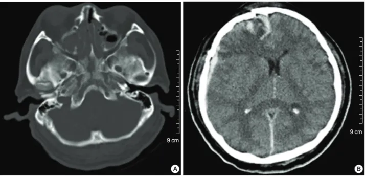 Fig. 1. Initial CT scan showing a longitudinal clivus fracture extending from the frontal basal skull fracture (A), and an acute subdural hem- hem-orrhage with a partial midline shift in the right frontotemporal region (B).