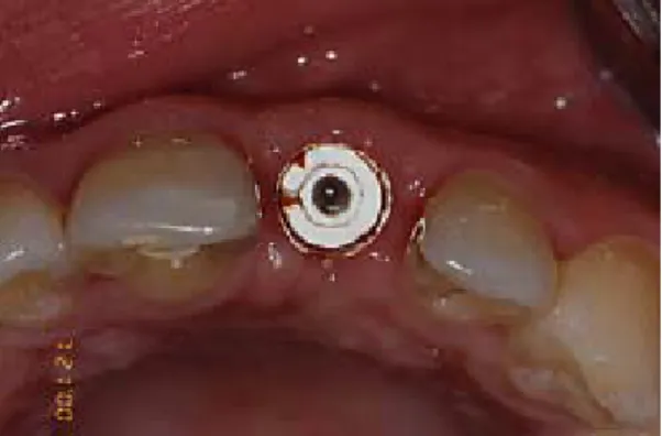 Fig. 5. Right  maxillary  central  incisor  was  set  with  temporary  crown.  A:  Frontal  view