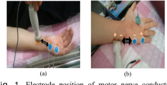 Fig. 1. Electrode position of motor nerve conduction  study in median and ulnar nerve