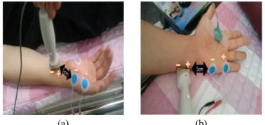 Fig. 3. Electrode position of F wave nerve conduction  study in median and ulnar nerve