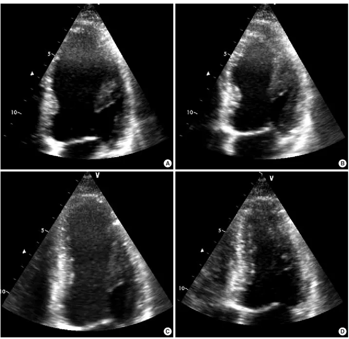 Fig. 1. An apical four-chamber view of the left ventricle in the emergency department is shown at end-diastole (A) and end-systole (B)