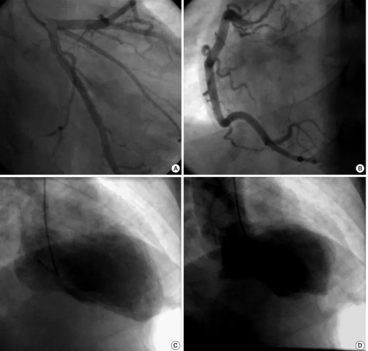 Fig. 2. The coronary angiogram showed normal left (A) and right coronary arteries (B)