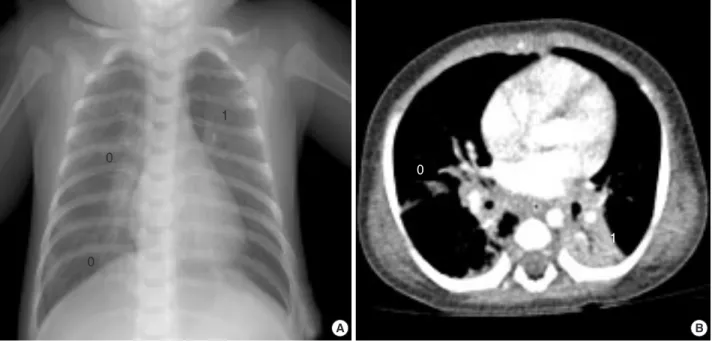 Fig. 1. Chest plain radiograph (A) and computed tomographic image (B) shows multifocal atelectases, peribronchial pneumonic infiltra- infiltra-tion and air-trapping of underlying lung parenchyme.