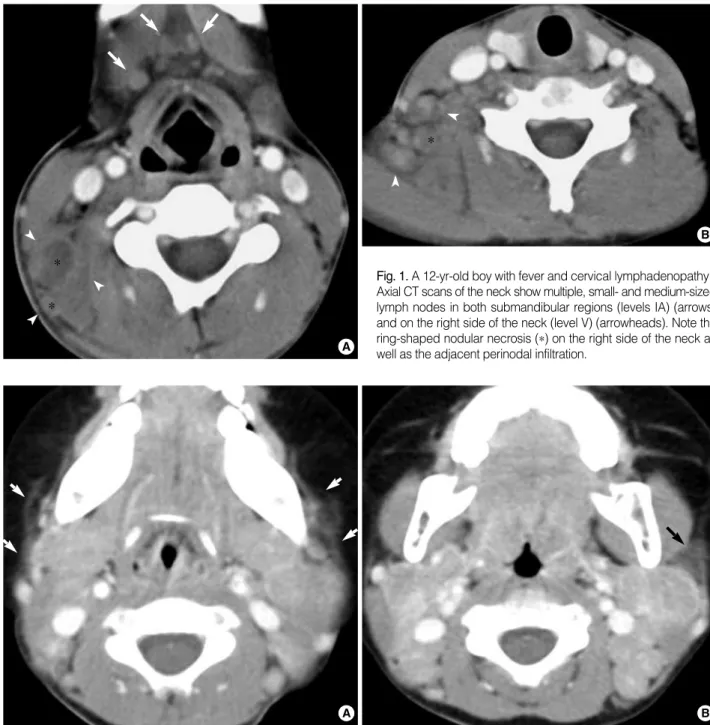 Fig. 2. A two-year-old girl with fever and bilateral cervical lymphadenopathy. Axial CT scans show multiple, medium-dimension lymph nodes with uniform enhancement on both sides of the neck at levels II and V