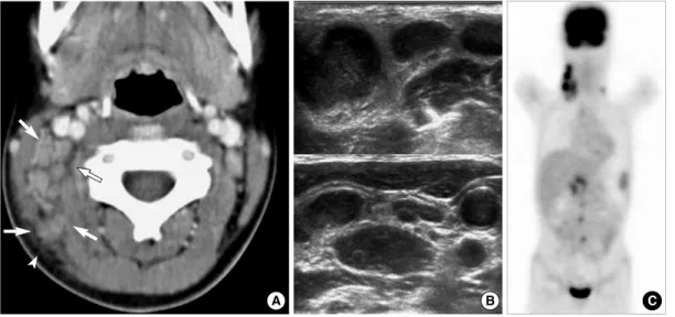 Fig. 3. A 10-yr-old girl with intermittent fever and right cervical lymphadenopathy. (A) CT scan shows multiple, small- and medium-sized lymph nodes on the right side of the neck (arrows) (levels IIB and V)
