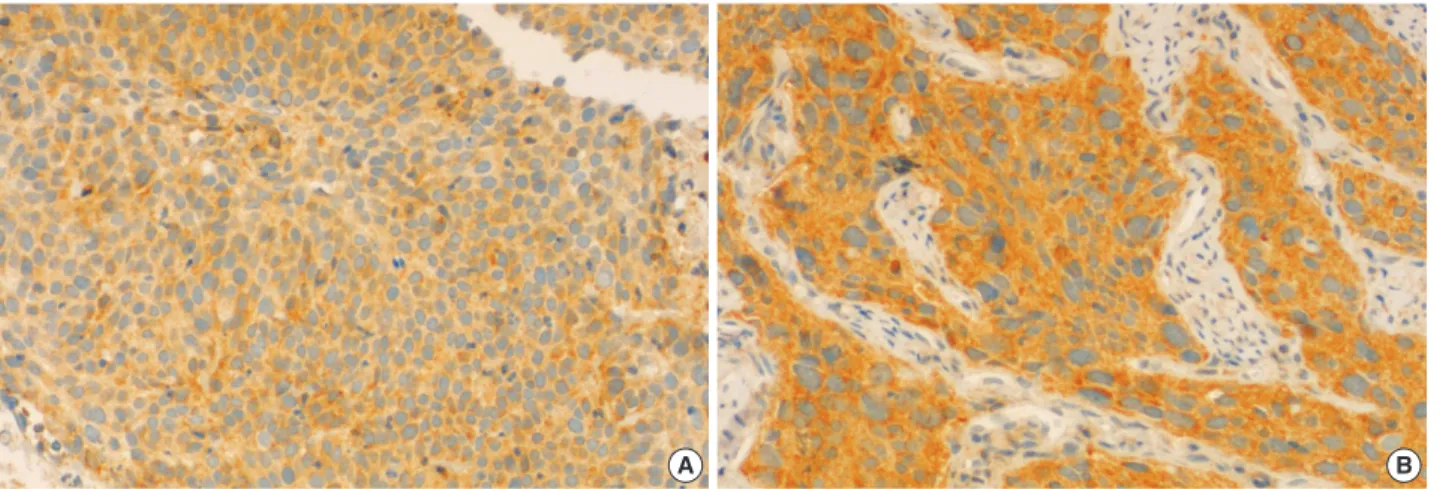 Fig. 1. Immunohistochemical staining of COX-2. (A) negative (<10% of distribution of immunoreactivity), (B) positive (≥10% of distribu- distribu-tion of immunoreactivity) (original magnificadistribu-tion ×200).