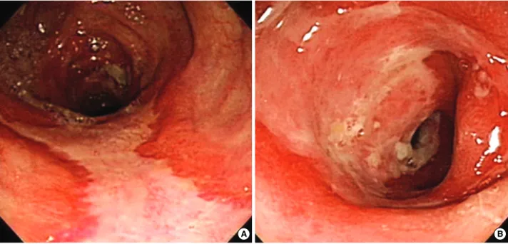 Fig. 1. A colonoscopy revealed multiple circumferential ulcerations in the distal ascending and transverse colon (A), and the follow-up colonoscopy performed one month later showed still remained multiple ulcerations in the transverse colon and the scope c