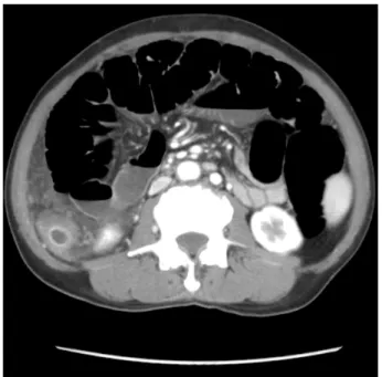 Fig. 4. Abdominal CT showed markedly dilated small bowel and a portion of colonic wall thickening.