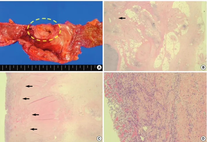 Fig. 5. Macroscopic examination showed a huge ulcerating mass-like lesion (dotted circle) at the cecum and the proximal ascending colon measuring about 7 ×5 cm with colonic wall thickening (A)