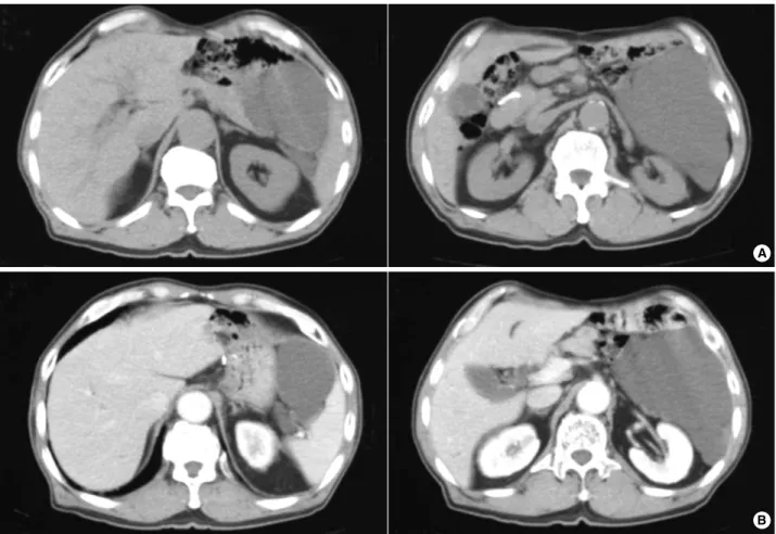 Fig. 2. Gross specimen showed an encapsulated cystic tumor combined with distal pancreas and spleen (A, Anterior view; B, Posterior view)