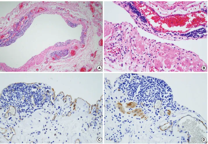 Fig. 3. Histology of lymphangioma. (A, B) Cystic wall was consisted of fibroconnective tissue accompanied by dilated lymphatic spaces and lymphoid cell aggregations in the endothelial lining of lymphatic vessels (H&amp;E  ×100, ×400)