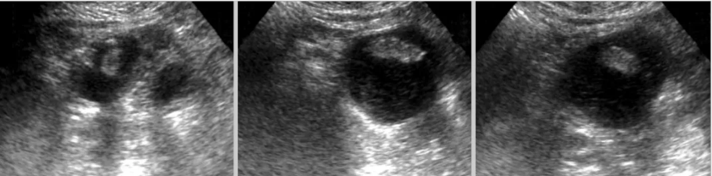 Fig. 2. Gallstones were identified within the dilated bowel as floating hyper-echoic foci producing distal acoustic shadowing reflec- reflec-tions, which moved when the patient’s position was changed