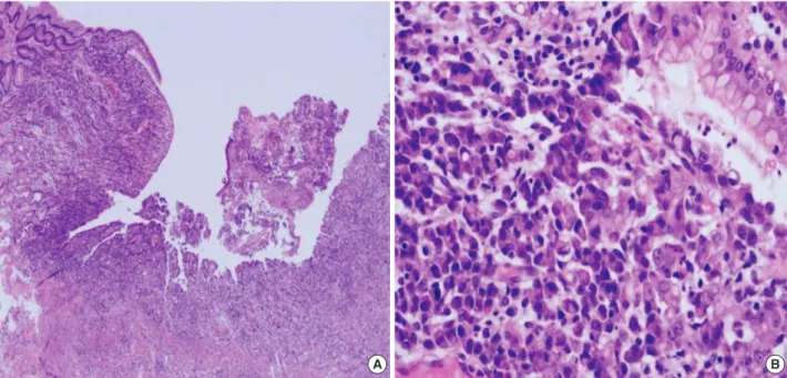 Fig. 3. Abdominal computed tomography findings one and half years after gastrectomy. There are newly developed multiple paraaortic lymph node enlargement