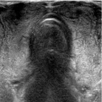 Fig. 4. Thyroid sonogram shows diffuse nodular enlargement of both lobes.