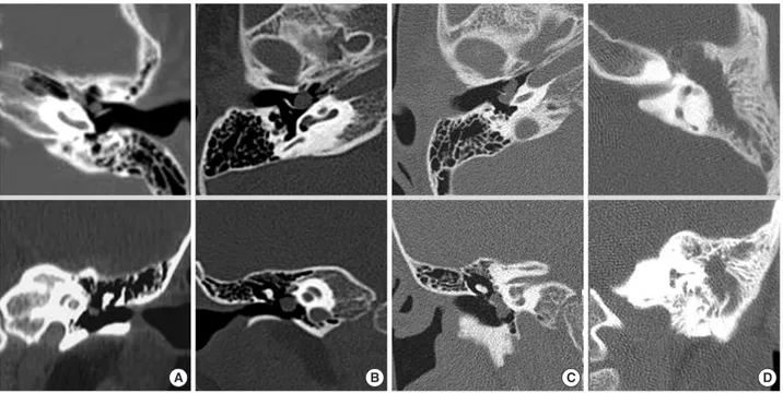 Fig. 1. Stage according to CT findings. (A) Stage I. Cholesteatoma occupies a single quadrant without ossicular extension