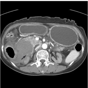 Fig. 2. Contrast-enhanced abdominal CT scan findings on the 3rd hospital day. A very large hematoma at the lateral duodenal wall, approximately 10×5 cm in diameter was identified