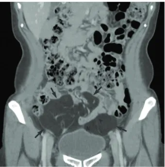 Fig. 2. A small bowel follow-through image shows upward devia- devia-tion of the entire small bowel loop, except for one segment of the ileal loop (arrows) entrapped within the prominent fatty tissue.