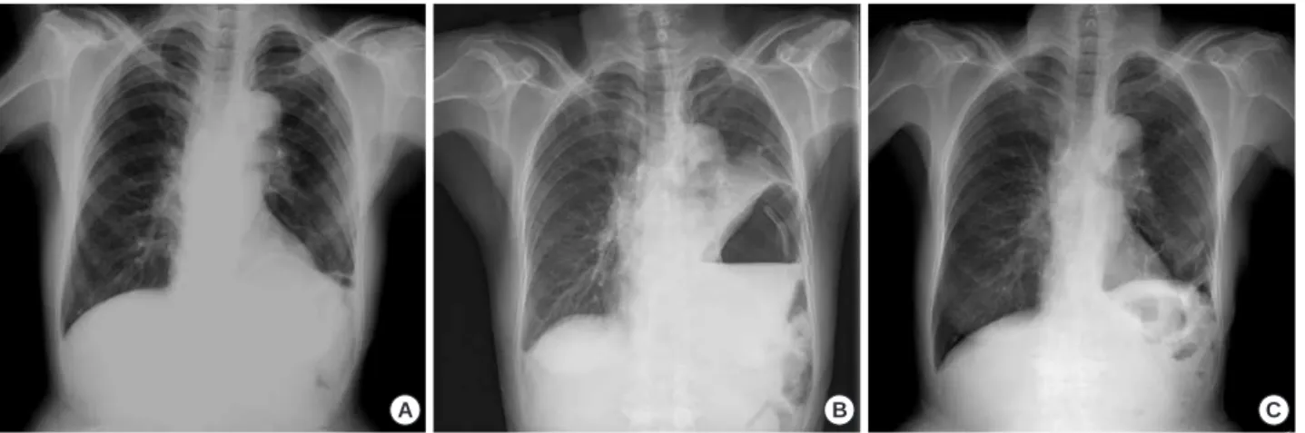 Fig. 1. Chest radiographies. (A) There was no abnormal finding reported on from the local clinic 4 days before admission