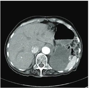 Fig. 4. Intraoperative findings. There was no diaphragmatic tissue.