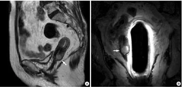 Fig. 1. MRI findings in this patient. (A) T2 weighted image (B) T2 weighted image using an endorectal coil