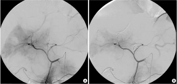 Fig. 1. Transcatheter arterial embolization of selective hepatic artery using PVA particles and micro-coils (Case No.1).