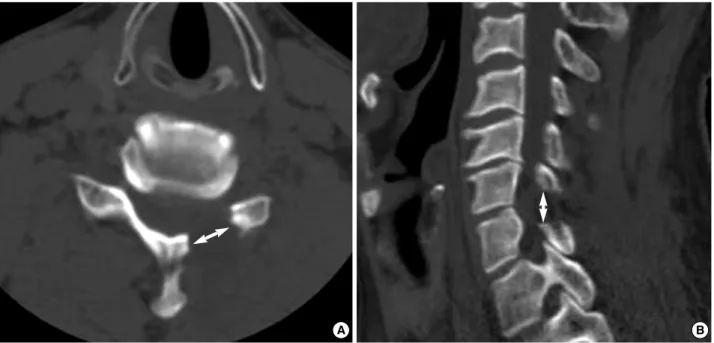 Fig. 1. Postoperative CT shows the foramintomy defect. (A) Transverse diameter (B) Vertical diameter.