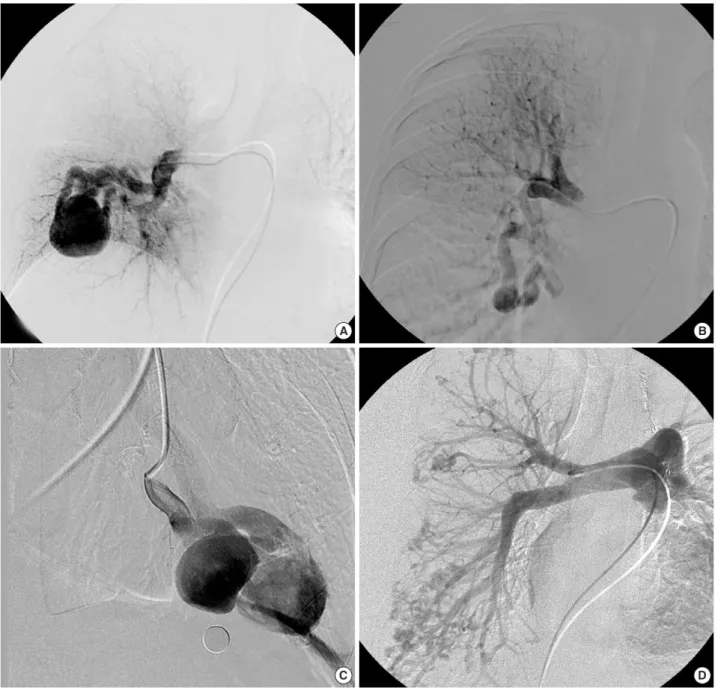 Table 1 gives a summary of the clinical features and results of mutation analysis. All the five patients showed the  typi-cal manifestations of HHT with variable individual  expres-sion of the clinical features
