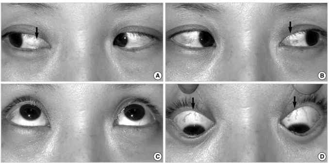 Fig. 1. Photographs of LVR (lateral and vertical version light-reflex) test measurements in dextroversion (A), levoversion (B), supraversion (C) and infraversion (D) of the right eye
