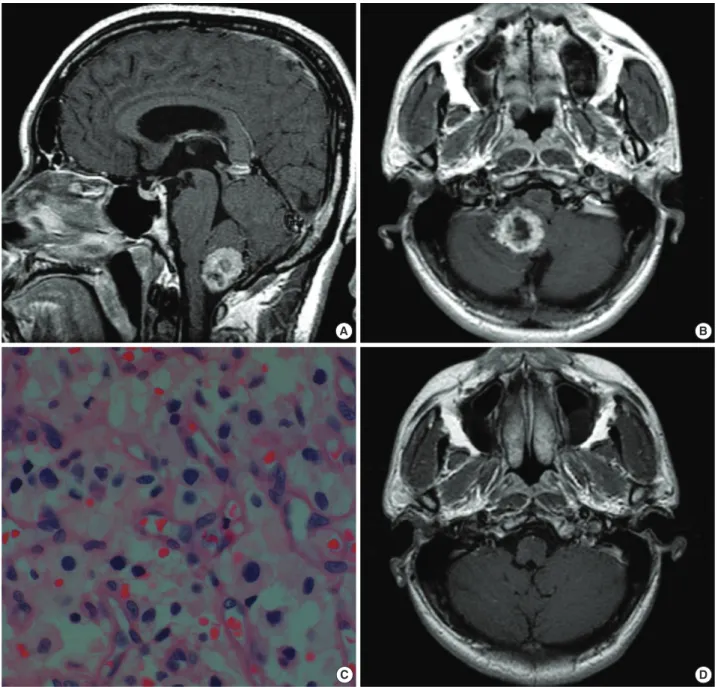 Fig. 1. Initial magnetic resonance images, pathology finding and postoperative MR images in first diagnosis
