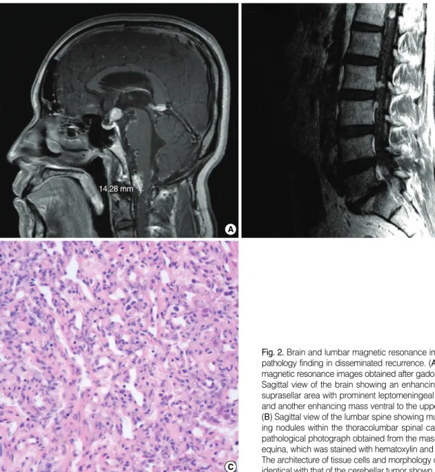 Fig. 2. Brain and lumbar magnetic resonance images and the pathology finding in disseminated recurrence