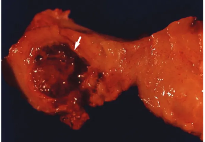 Fig. 2. Cut surface of the cervical wall showing well defined hem- hem-orrhagic solid lesions (arrow).