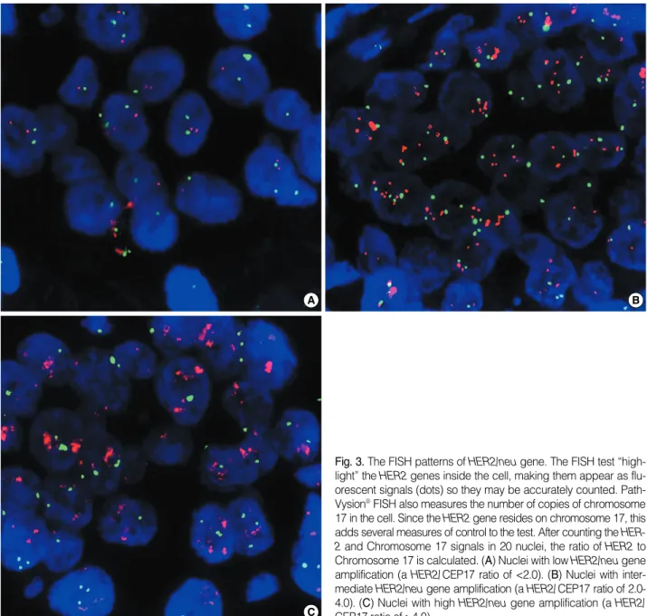 Fig. 3. The FISH patterns of HER2/neu gene. The FISH test “high- “high-light” the HER2 genes inside the cell, making them appear as  flu-orescent signals (dots) so they may be accurately counted