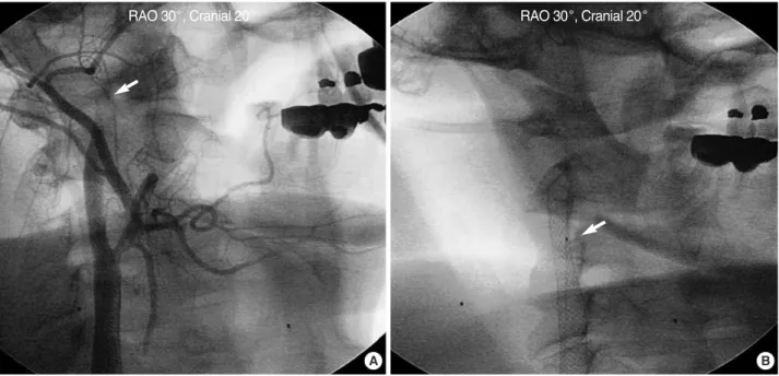 Fig. 3. After aspiration thrombectomy, antegrade flow was fully re- re-stored.