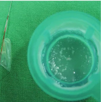 Fig. 4. After retrieval of FilterWire EX, whitish debris was noted within the basket.