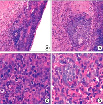 Fig. 7. The histology of the neoplastic tissue under light microscope. (A, B) The  neoplastic tissue shows structurally disordered, with large areas of necrosis tissue  (H&amp;E, ×200); (C, D) The cells have marked cellular atypia, with giant nucleus,  aug
