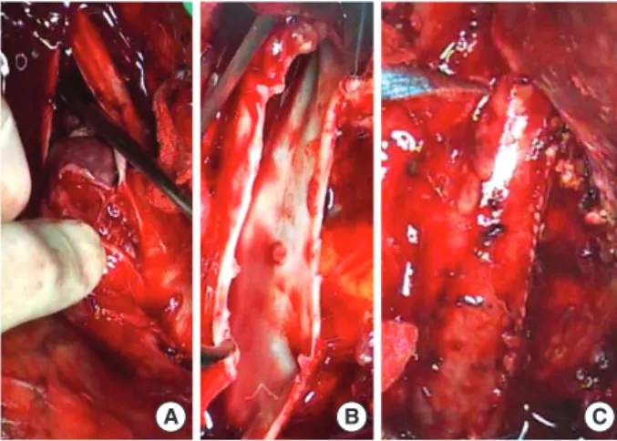 Fig. 1. Operative pictures. After full exposure of the involved seg- seg-ment of the inferior vena cava (IVC), upper margin of thrombus (A) and presence of remaining thrombus attached to the venous wall is identified under direct vision (B)