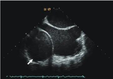 Fig. 3. Left ventricular pseudoaneurysm (arrow) from medial aspect of MVR site through tortuous tract.