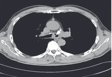 Fig. 1. Chest computed tomogram showing the protruding lesion (arrow) in the  posterior portion of trachea