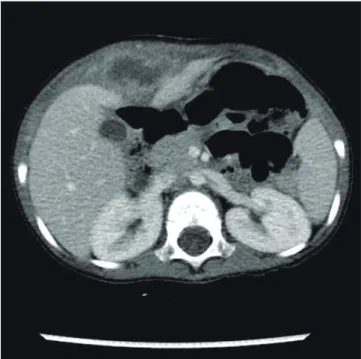 Fig. 2. The falciform ligament abscess was completely excised from the abdominal  wall.