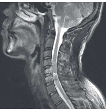 Fig. 1. C5 and C6 wedge  compression fractures  with minimal C5 retroli­