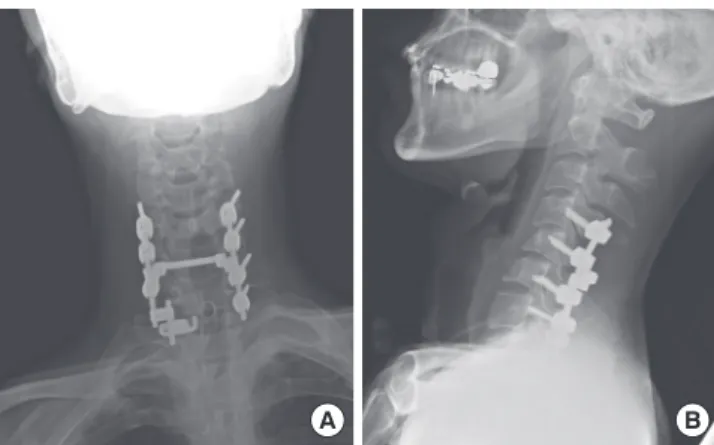 Fig. 5. Summarization of the hypothesized mechanism of the injury. (A) During the  initial short moment of the collision, the airbag is just in contact with the torso, but  not with the face of the patient