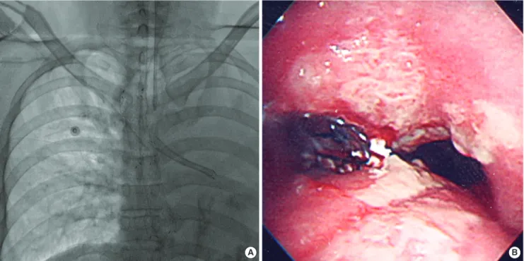 Fig. 2. A multi-planar reformatted oblique coronal CT image obtained six days after  the bronchial stent placement shows the bronchial stent in the left main bronchus  with internal bubbly material, suggesting secretion and an aerated left lung.