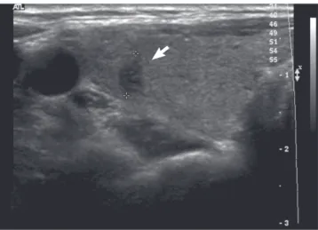 Fig. 2. The  99m Technetium thyroid scan showed diffuse enlargement of both lobes of  the thyroid with homogenously increased uptake (10.1%).