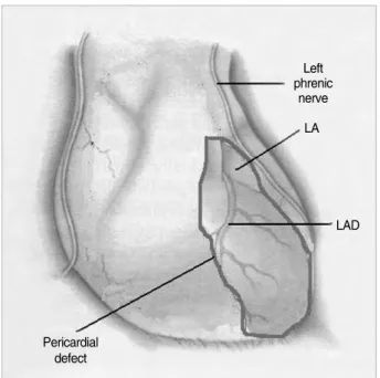 Fig. 2. Schematic drawing depicting the intra-operative findings.