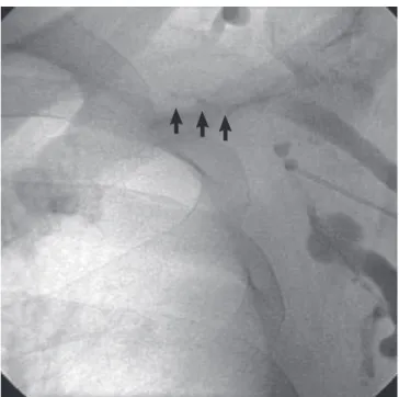 Fig. 2. (A) Chest PA after ICD implanta­