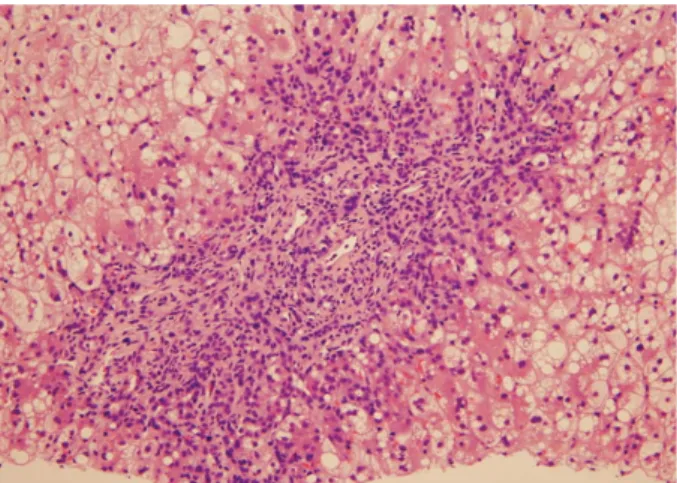 Fig. 1. Percutaneous liver biopsy exhibited ballooning or feathery degeneration and macrovesicular fat droplets in lobular  hepato-cytes and periportal fibrosis and ductular proliferation in a portal space