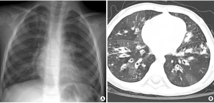 Fig. 1. Chest radiographs on admission. (A) Chest plain radiograph shows diffuse reticulonodular densities in both central lung areas sym- sym-metrically