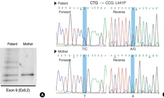 Fig. 2. Denaturing gradient gel electrophoresis (DGGE) and nucleotide sequencing. (A) DGGE on CFTR exon 9 using the DNA sample from patient shows a typical heterozygote banding pattern containing heteroduplex bands (see reference no
