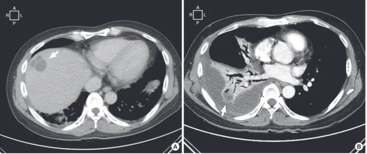Fig. 1. Contrast-enhanced computed tomography (CT) scan images. (A) An abdominal CT scan showed a low attenuating lesion 3.4 cm in size on the superior subcapsular  portion of liver segment 8, which was suggestive of liver abscess (arrow)
